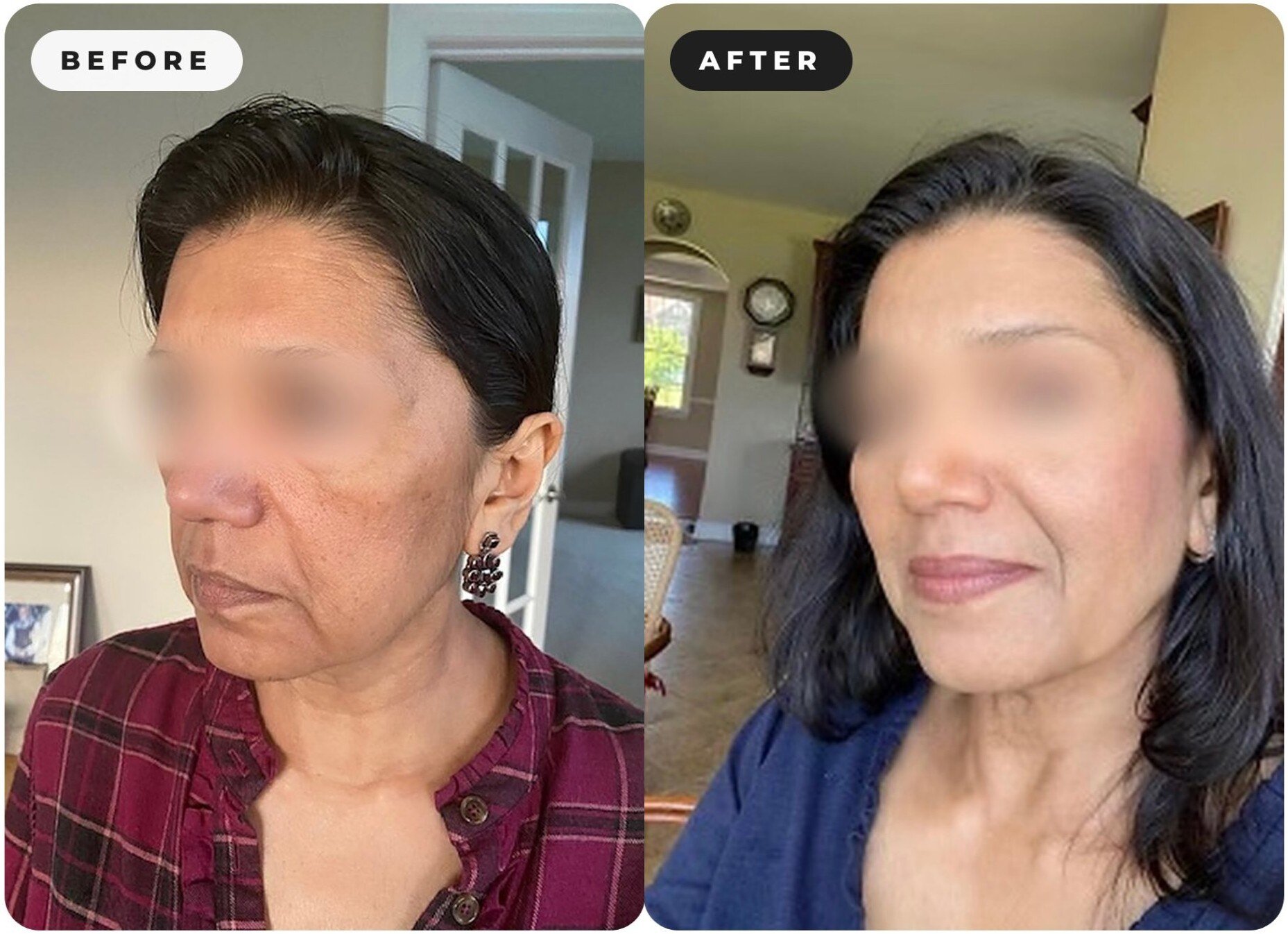 Real client before and after: lifted, brighter, refreshed