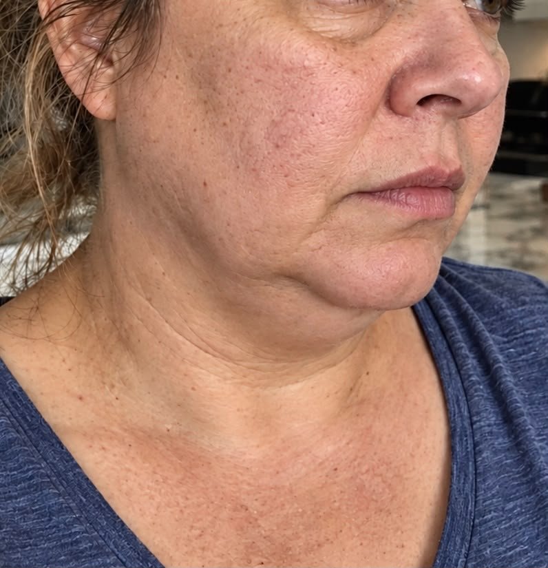 A client in profile before: softness under the chin and along the jaw