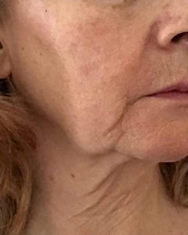 A client's lower face before: jowls collecting along the jaw