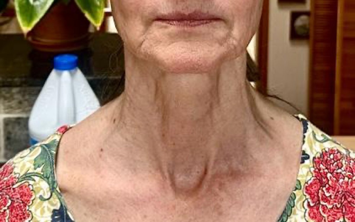 The same client's neck and jawline after