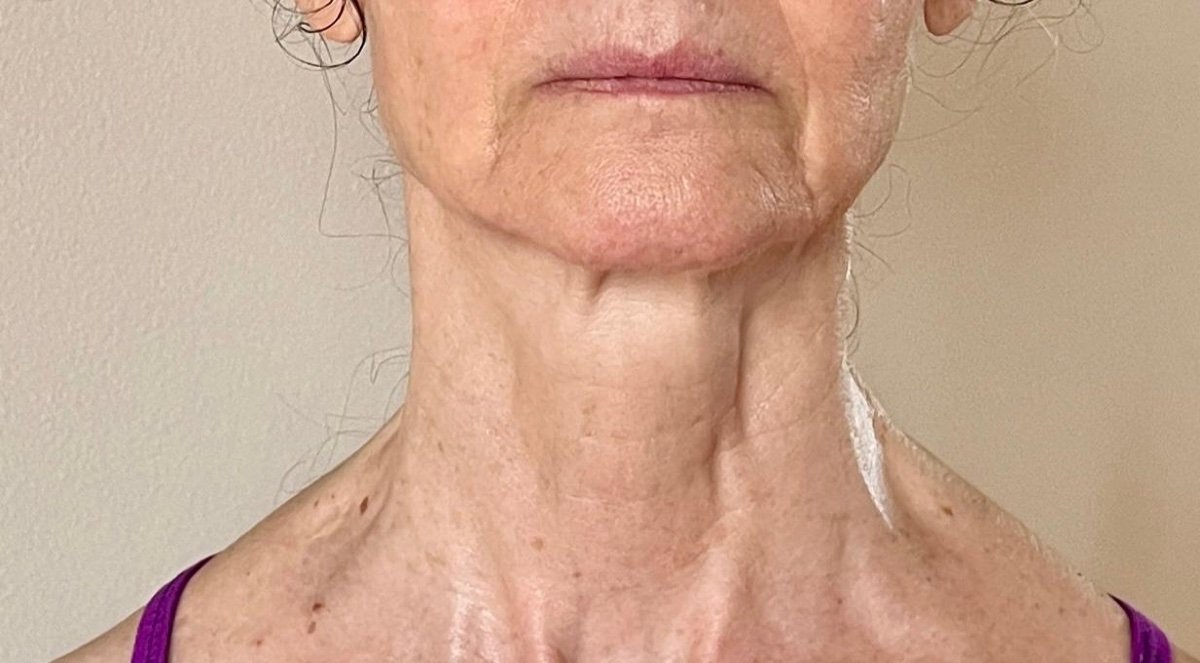 A client's neck and jawline before