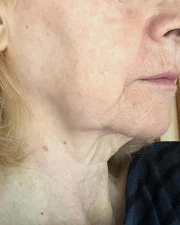 The same client's neck and jawline after face yoga