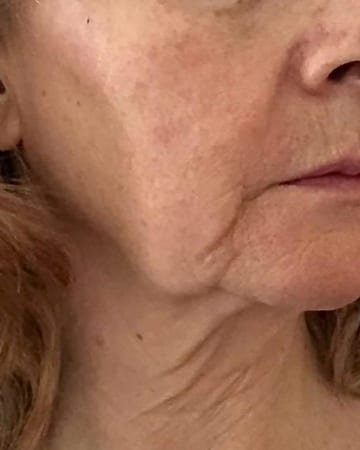 A client's neck and jawline before face yoga
